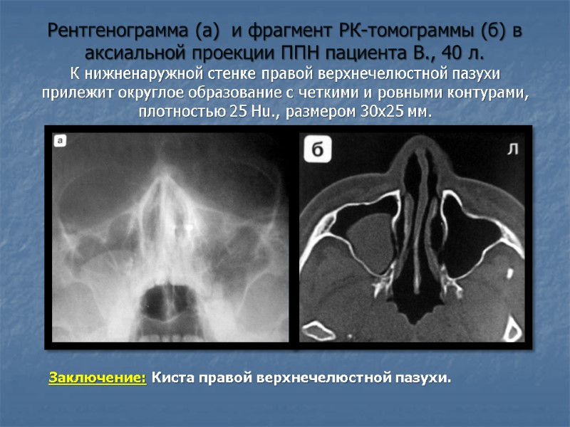 Рентгенограмма (а)  и фрагмент РК-томограммы (б) в аксиальной проекции ППН пациента В., 40
